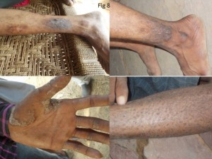 Skin Infections